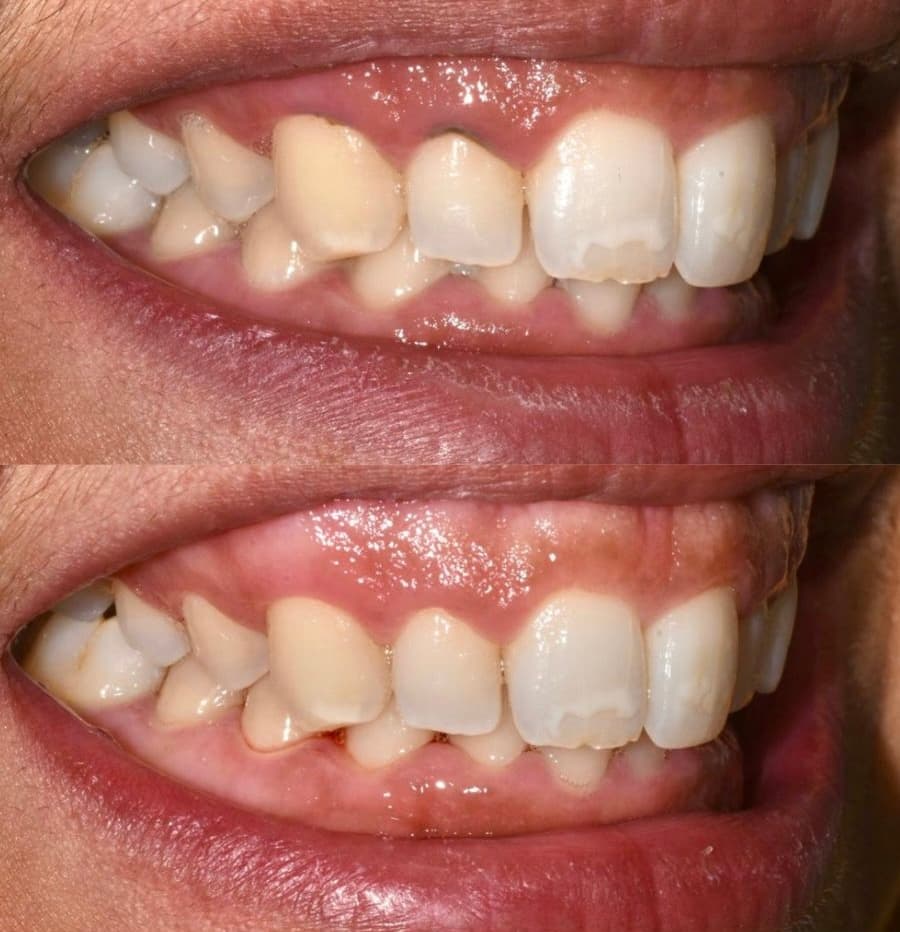 Limpieza Periodontal